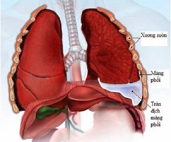Điều dưỡng chăm sóc bệnh nhân tràn dịch màng phổi