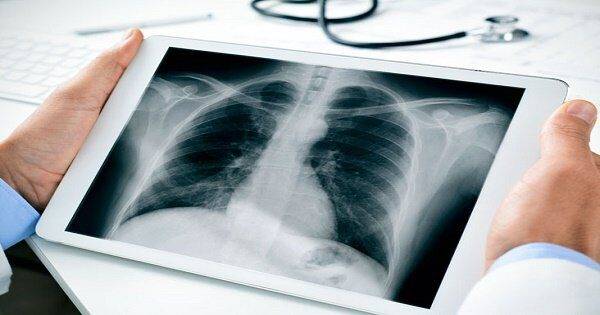 Chụp X-quang là gì: Tất cả những điều cần biết