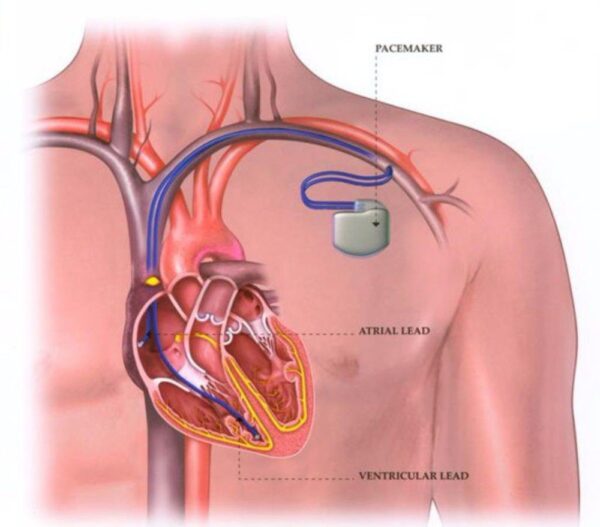Cấy máy tạo nhịp tim điều trị rối loạn nhịp tim chậm
